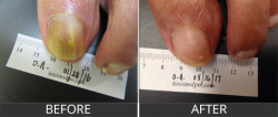 Toenail fungus repair in Tucson by Dr. Darin Alan Bocian.