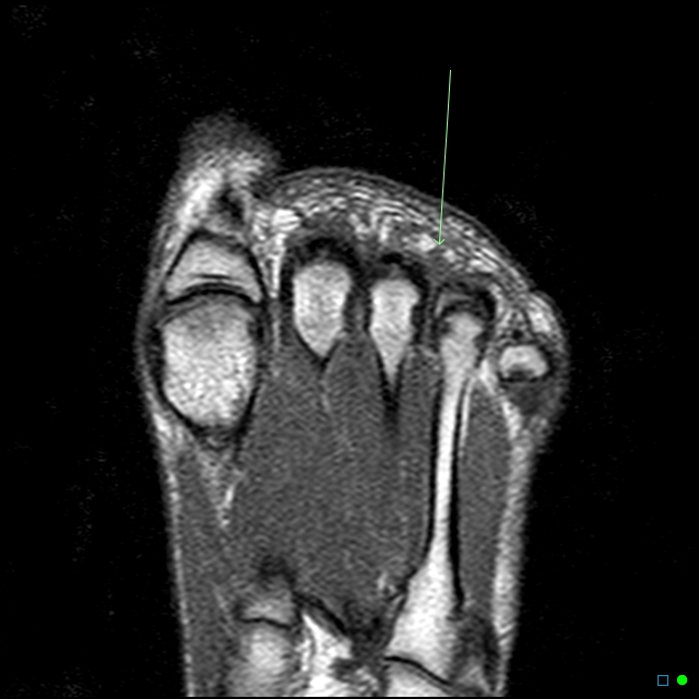 X-rays of bunions by Dr. Darin Alan Bocian podiatry